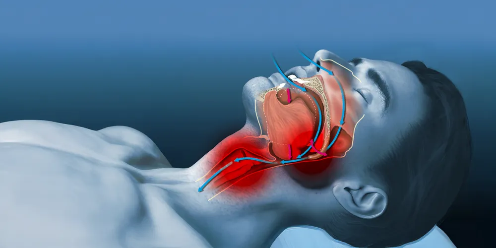 Snoring solution hero image